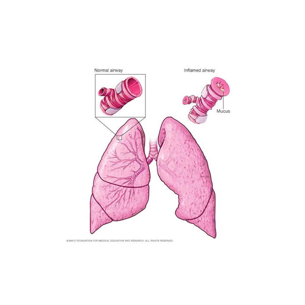 Astm: simptome, tratament și prevenire