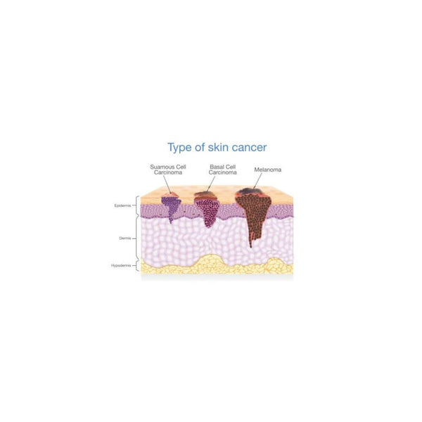 Cancerul de piele și melanom