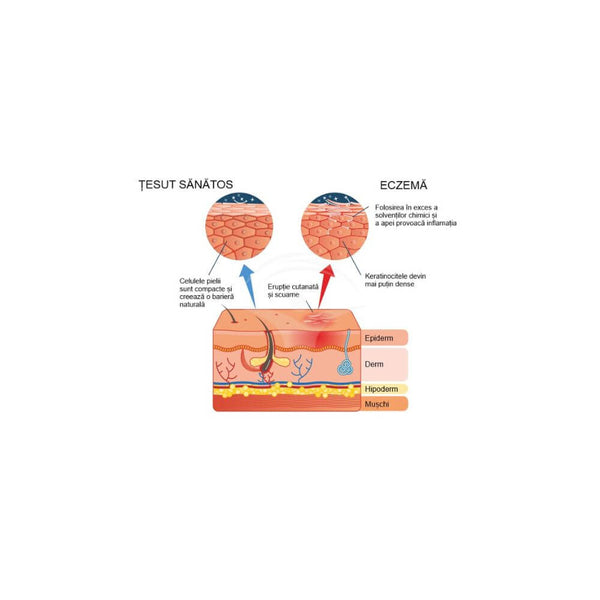 Cum se tratează eczema?