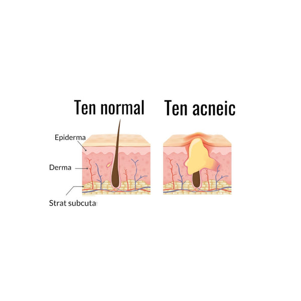 Diagnosticarea și tratarea acneei