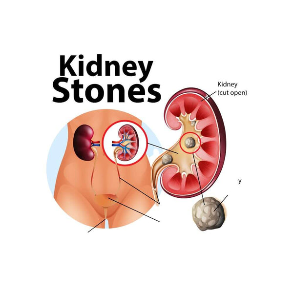 Tot ce trebuie să știți despre pietrele la rinichi