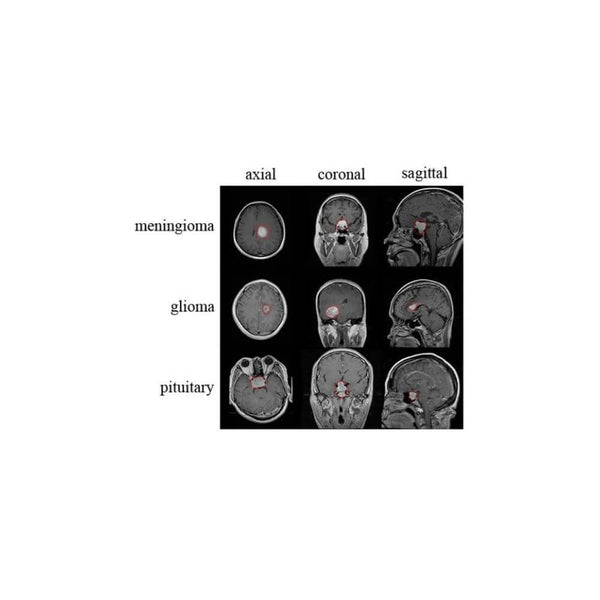 Tumori cerebrale: cauze, simptome și complicații