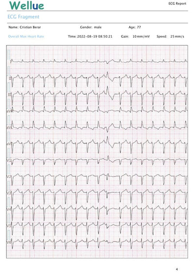 Holter EKG (ECG) -24h, personal cu interpretare AI, in mod continuu - DEFIRO